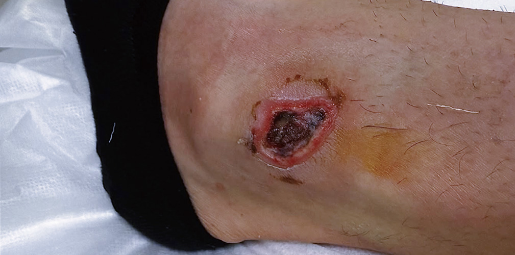 Martin Marcellusi, ferita malleolo