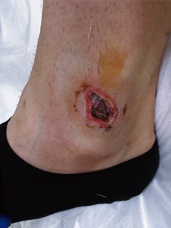 Martin Marcellusi, ferita malleolo