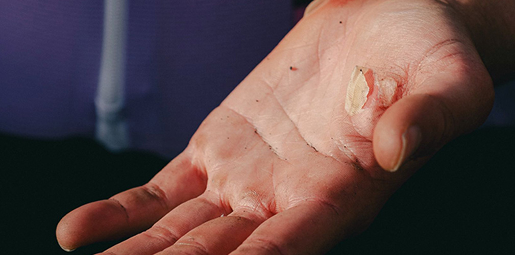 Tonetti ha pagato con le vesciche la scelta azzardata di correre la Roubaix senza guanti (foto Jon Olarte)