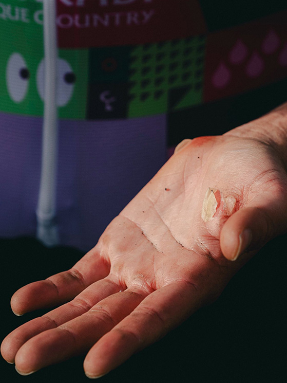 Tonetti ha pagato con le vesciche la scelta azzardata di correre la Roubaix senza guanti (foto Jon Olarte)