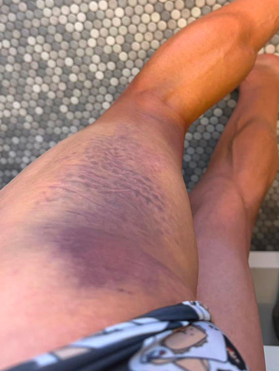 Roglic ha rischiato di saltare la Vuelta a causa di un investimento che lgi ha procurato un grosso ematoma (immagine Instagram)
